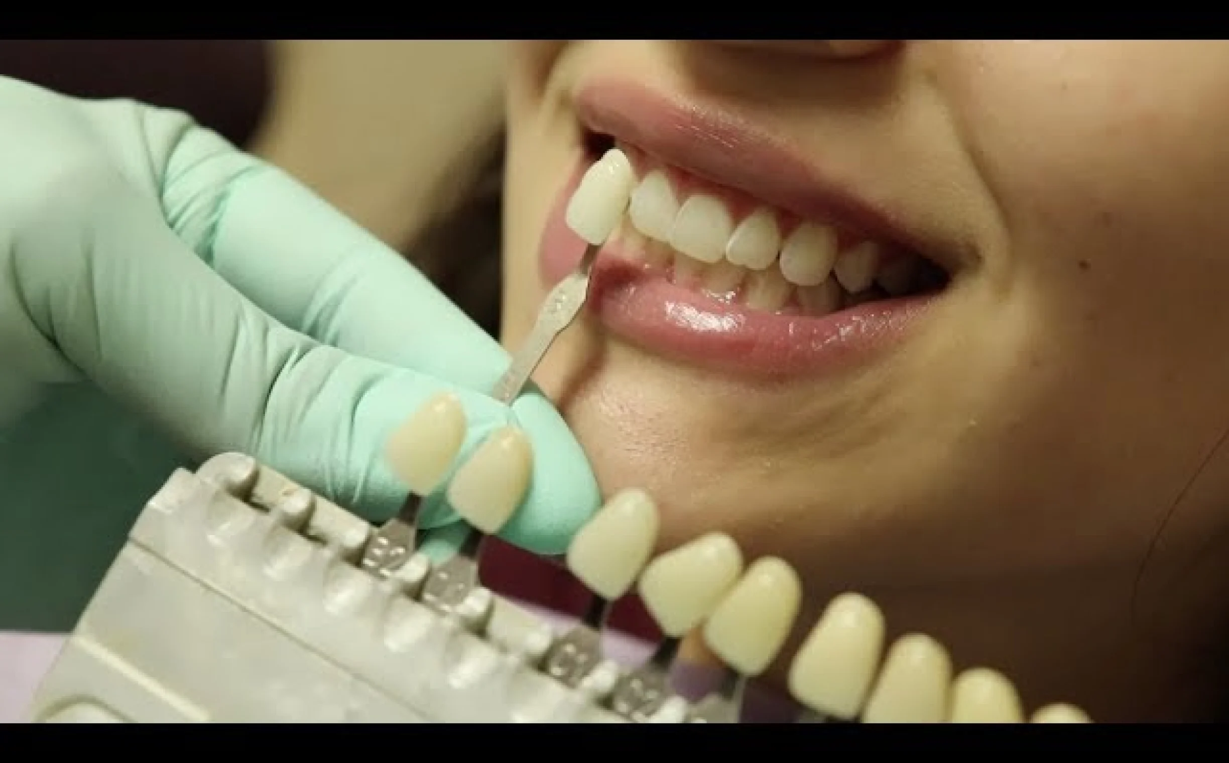 Hygienist Amy’s Philips Zoom whitening video: shade guide held next to a smile