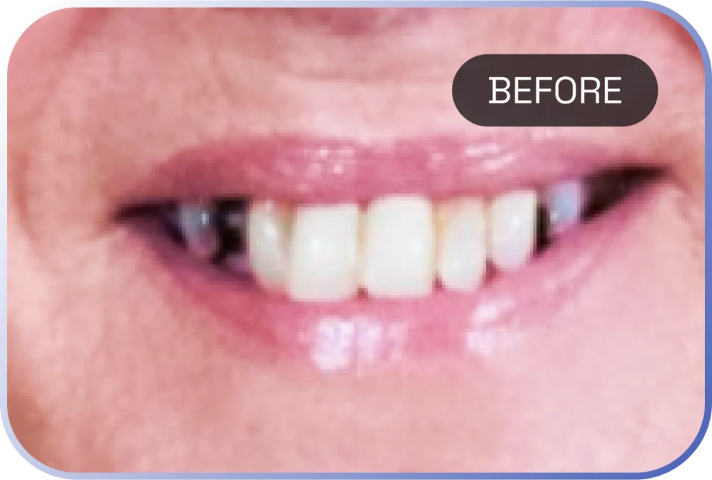 Before treatment: smile with missing and uneven upper teeth